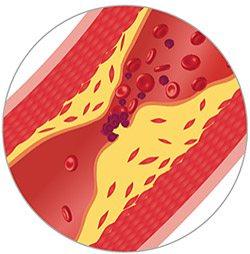 Elimina depunerile de colesterol de pe vasele de sange in doar 40 de zile